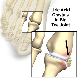 uric acid gout dyn, uric acid, what is uric acid