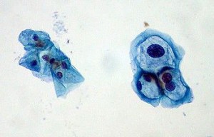 ThinPrep Pap smear HPV, HPV virus, HPV ThinPrep Pap smear HPV, HPV virus, HPV