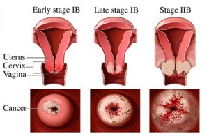 cervical cancer, cervical cancer stage